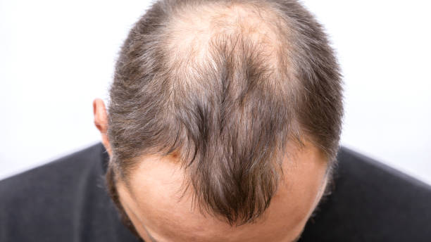 Causes of hair loss.